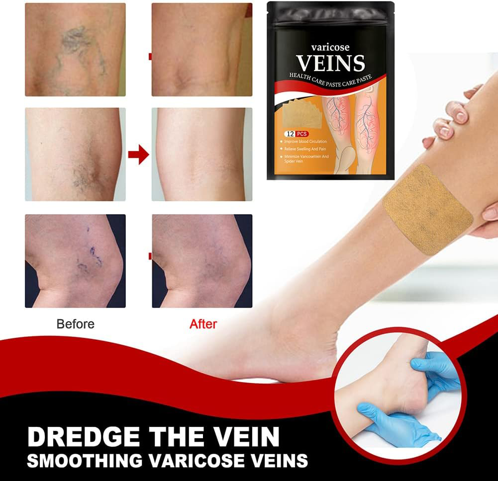 Varicose Vein Patches